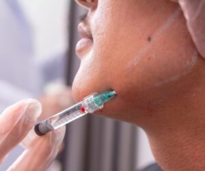 Volumen zurück und Konturen schärfen: So verändern sich Gesichter durch gezielte Filler-Behandlung